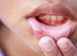 آفت دهان - درمان آفت دهانی با طب سنتی