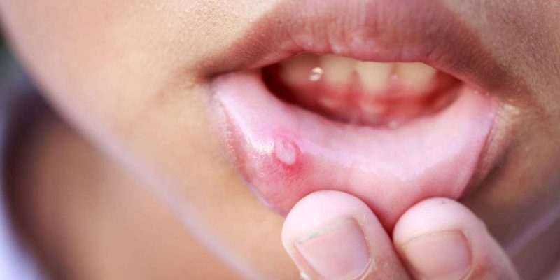 آفت دهان - درمان آفت دهانی با طب سنتی