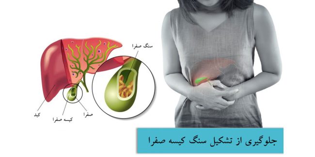 کیسه صفرا - جلوگیری از تشکیل سنگ صفرا با طب سنتی