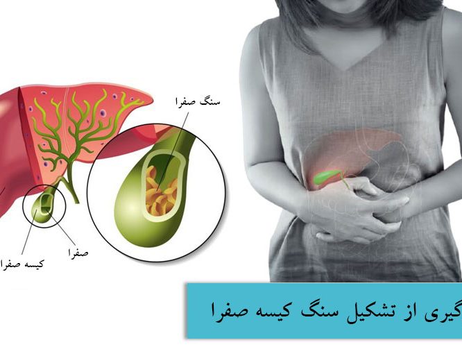 کیسه صفرا - جلوگیری از تشکیل سنگ صفرا با طب سنتی