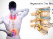 بیماری دیسک کمر و توصیه های درمانی طب سنتی برای کمردرد