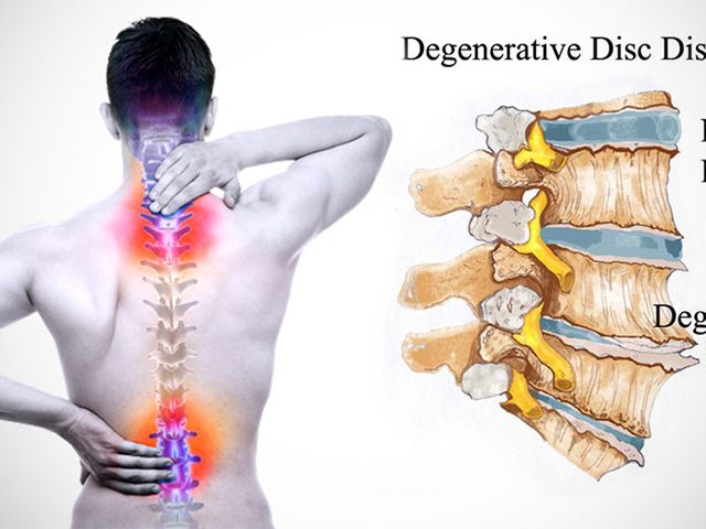 بیماری دیسک کمر و توصیه های درمانی طب سنتی برای کمردرد