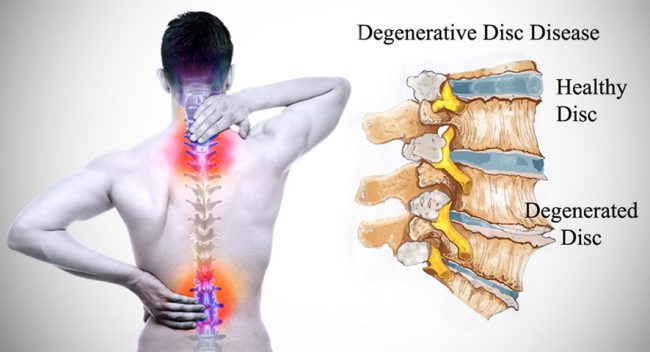 بیماری دیسک کمر و توصیه های درمانی طب سنتی برای کمردرد