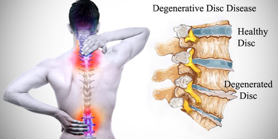 بیماری دیسک کمر و توصیه های درمانی طب سنتی برای کمردرد