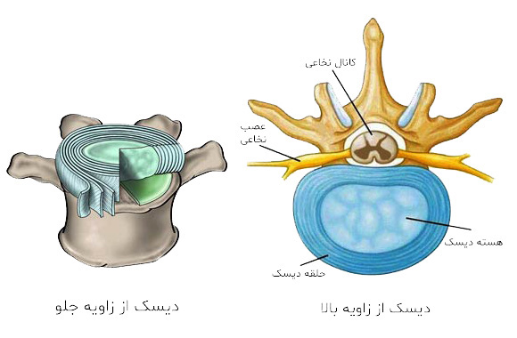 دیسک کمر