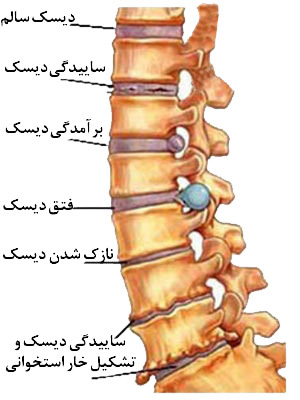 انواع بیماری دیسک کمر